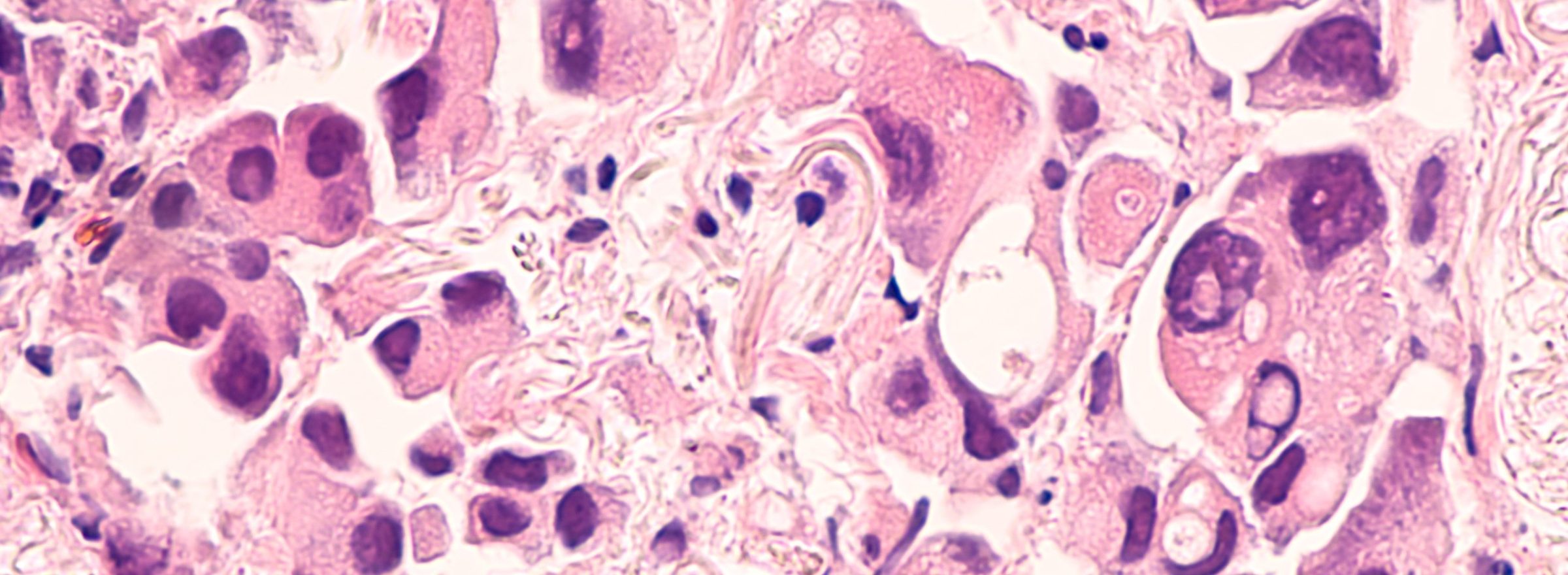 Lung,Cancer,-,Adenocarcinoma:,Therapies,For,Specific,Genetic,Mutations,(biomarkers